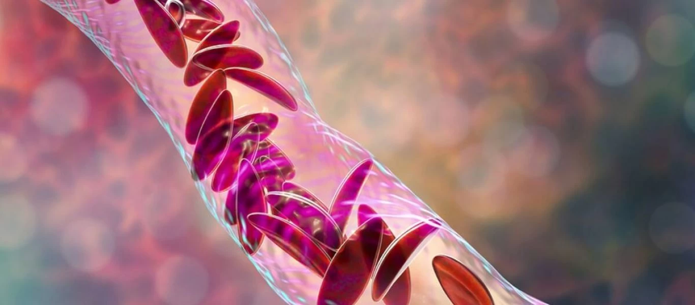 Αυτές είναι οι αιτίες εμφάνισης χαμηλού αιματοκρίτη